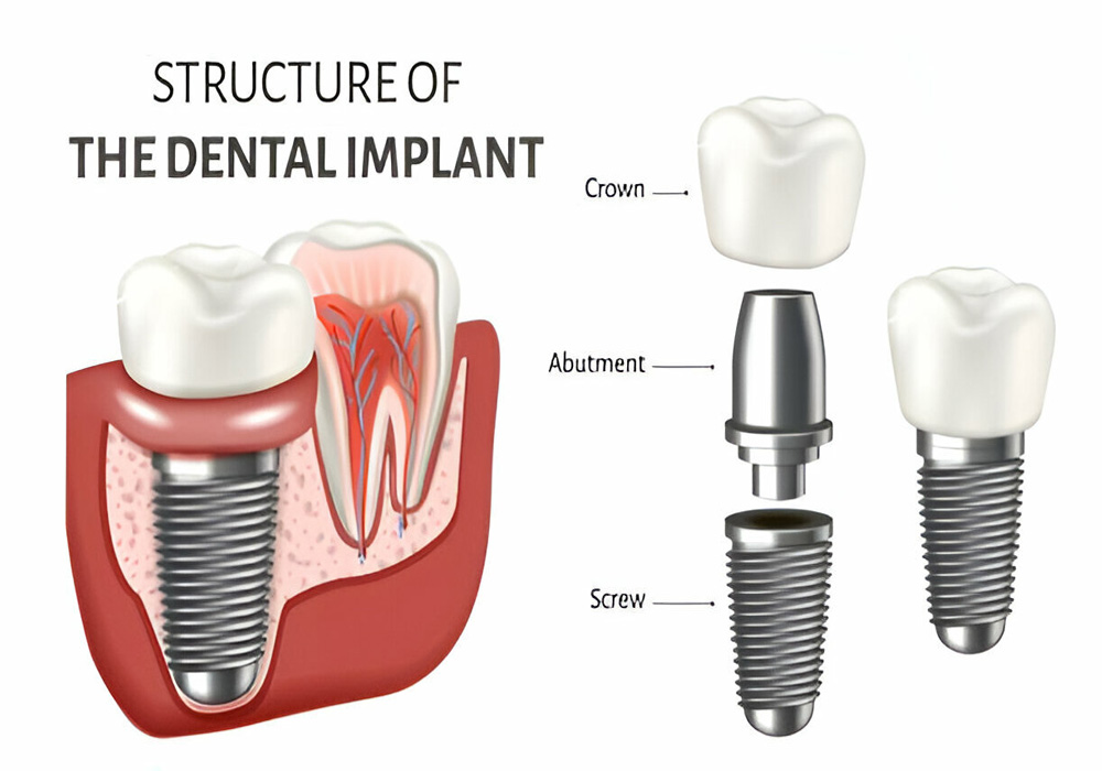 Dental Implants near you