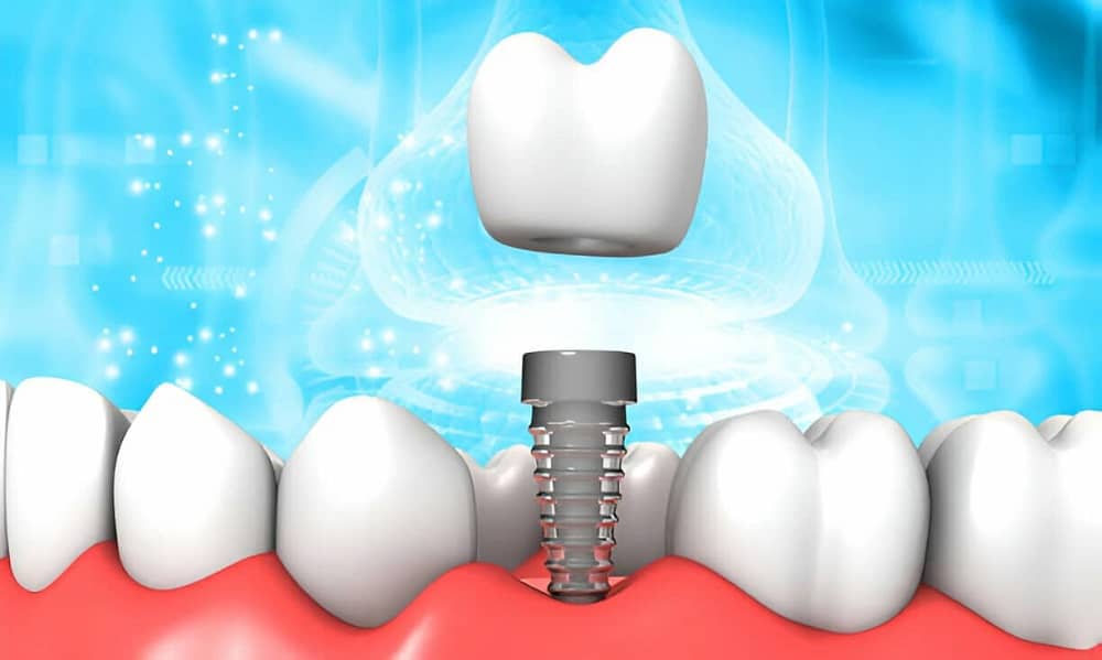 Top 5 Benefits of Choosing Dental Implants for Tooth Replacement